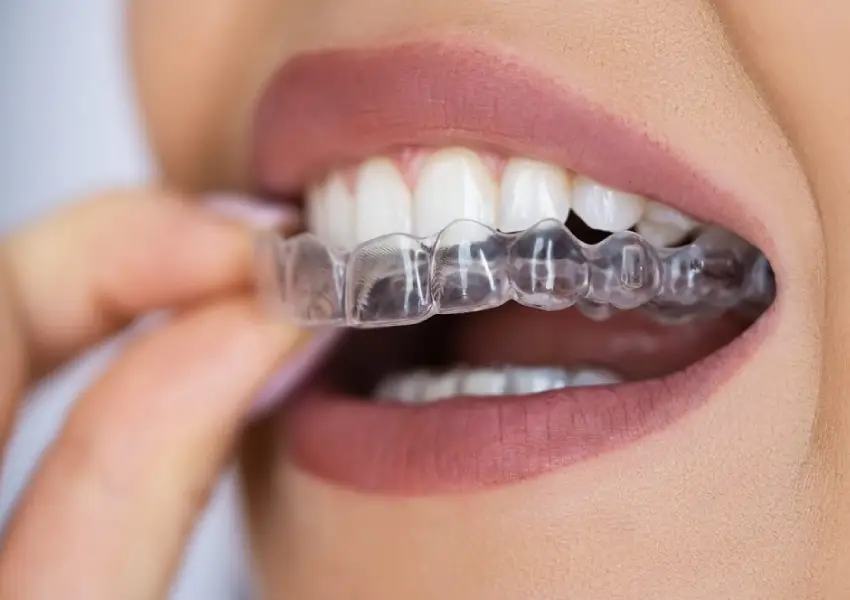 Clear aligner consultation and digital smile scanning
