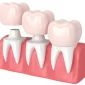 crowns bridges dentures 85x85
